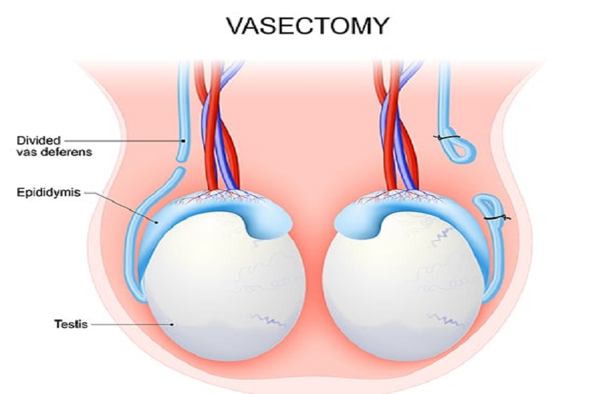 Preparing for a Vasectomy in Sacramento CA