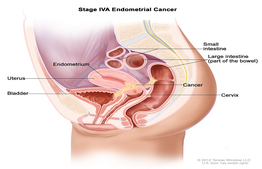 Dr. Paolo Boffetta - What Should Women Know About The 3 Key Causes of Uterine Cancer